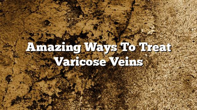 Amazing ways to treat varicose veins