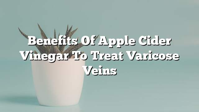 Benefits of apple cider vinegar to treat varicose veins