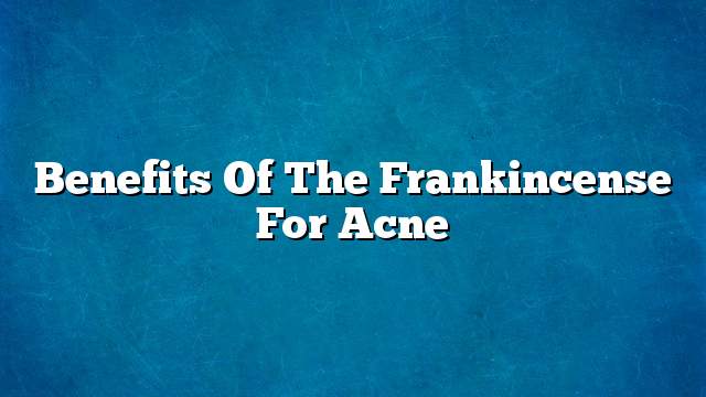 Benefits of the frankincense for acne