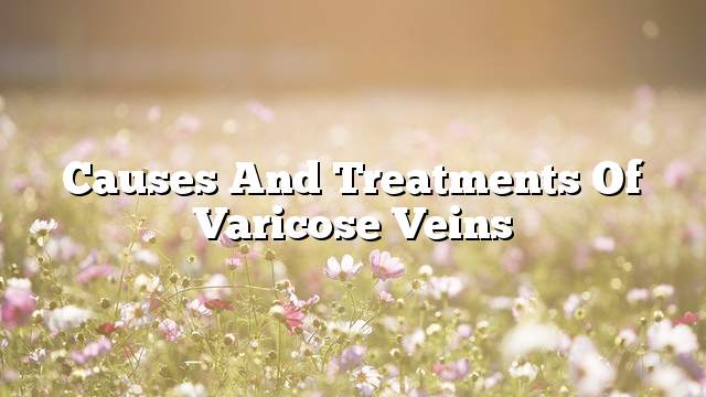 Causes and treatments of varicose veins