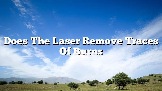 Does the laser remove traces of burns