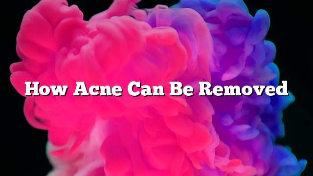 How Acne Can Be Removed