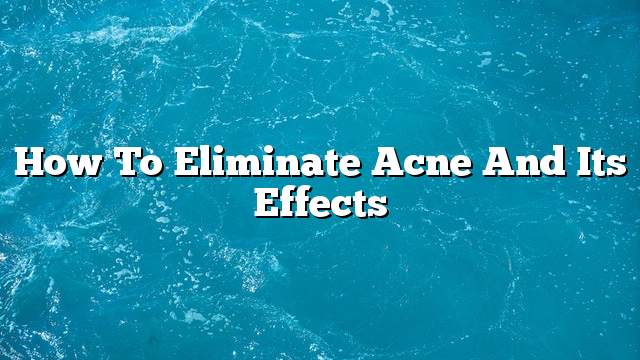 How to Eliminate Acne and its Effects