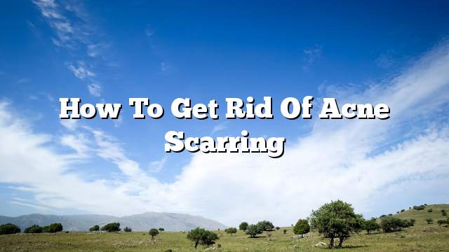 How To Get Rid Of Acne Scarring