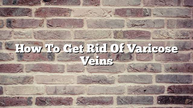 How to get rid of varicose veins