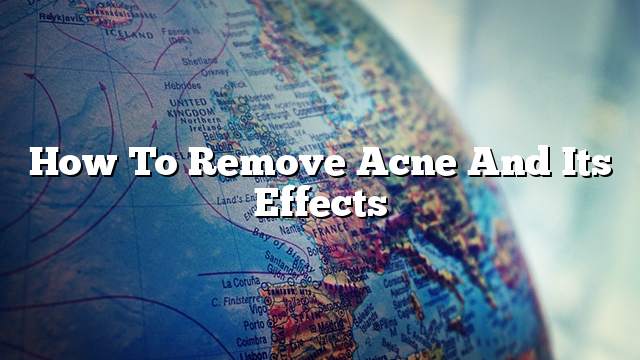 How To Remove Acne And Its Effects