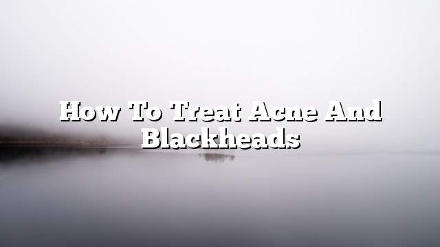 How to Treat Acne and Blackheads