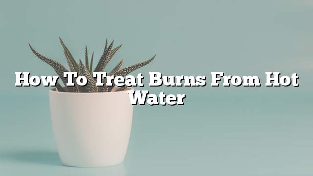 How to treat burns from hot water