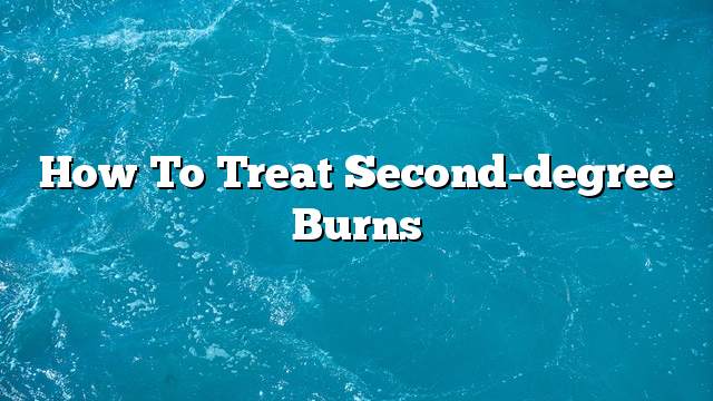 How to treat second-degree burns