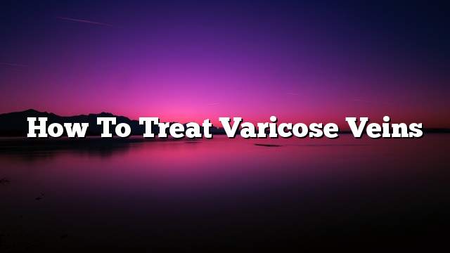 How to treat varicose veins