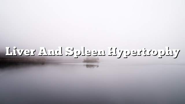 Liver and spleen hypertrophy