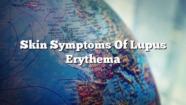 Skin symptoms of lupus erythema