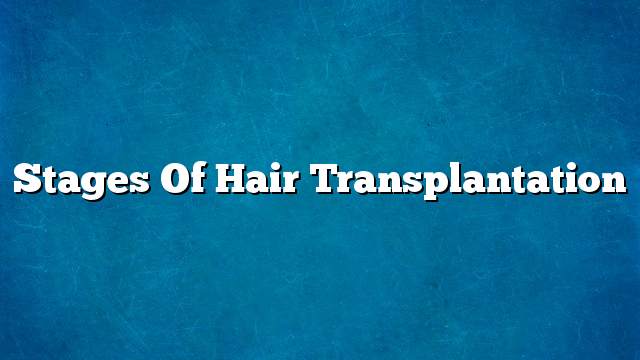 Stages of hair transplantation