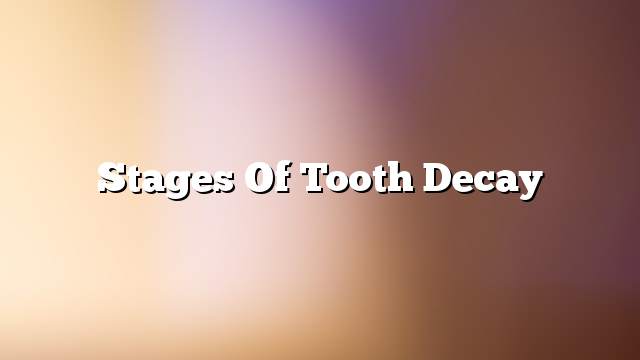 Stages of tooth decay