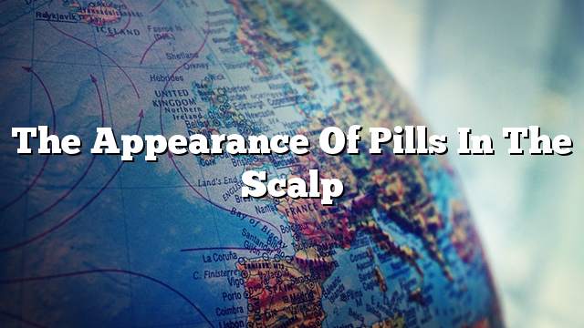The appearance of pills in the scalp