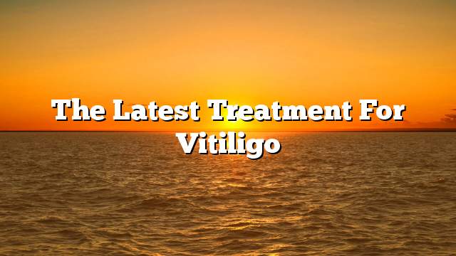 The latest treatment for Vitiligo