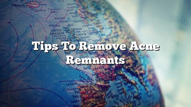 Tips to remove acne remnants
