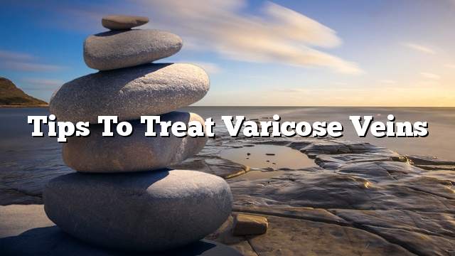 Tips to treat varicose veins