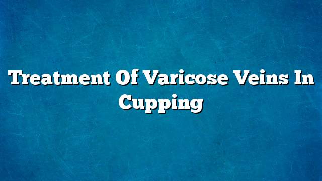 Treatment of varicose veins in cupping