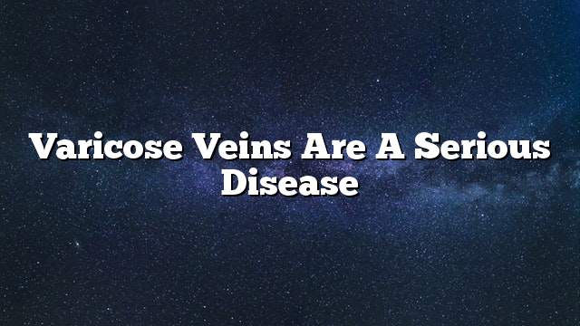 Varicose veins are a serious disease