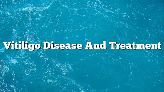 Vitiligo disease and treatment