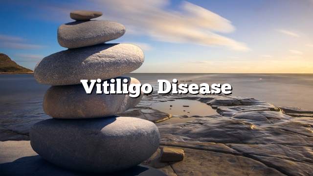 Vitiligo disease