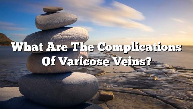 What are the complications of varicose veins?