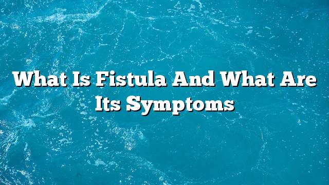 What is fistula and what are its symptoms