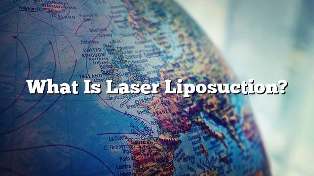 What is laser liposuction?