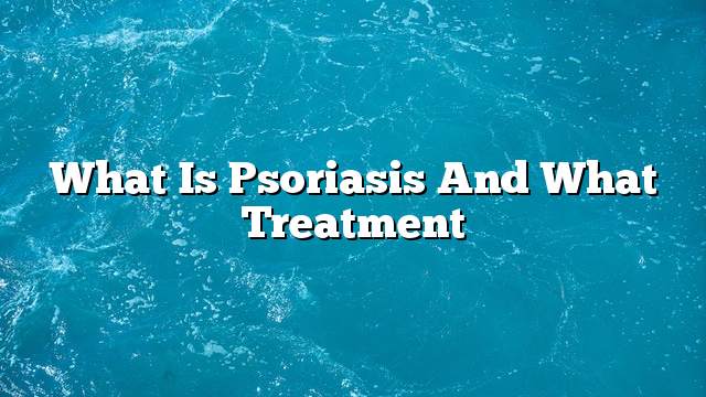 What is psoriasis and what treatment