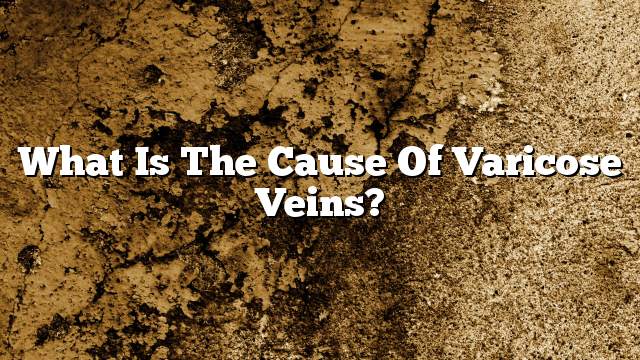 What is the cause of varicose veins?